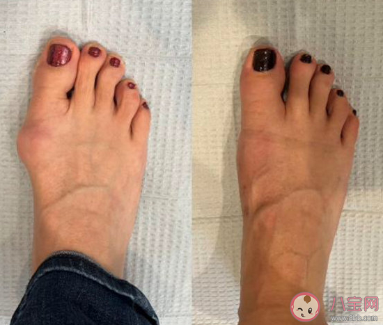 如何判斷自己是否有拇外翻 拇趾外翻穿矯正器有用嗎 如何判斷自己是否有拇外翻 拇趾外翻穿矯正器有用嗎