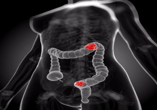 怎么判斷自身患癌風險高不高 有家族史如何防癌