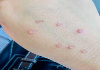 扁平疣是性病嗎 扁平疣有什么典型特征