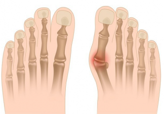 如何判斷自己是否有拇外翻 拇趾外翻穿矯正器有用嗎