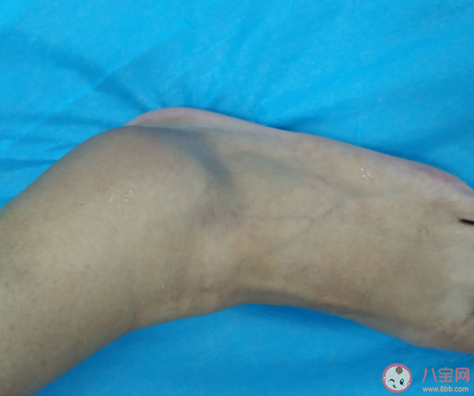 不小心崴到腳該冰敷還是熱敷 崴腳以后如何處理好得快 不小心崴到腳該冰敷還是熱敷 崴腳以后如何處理好得快