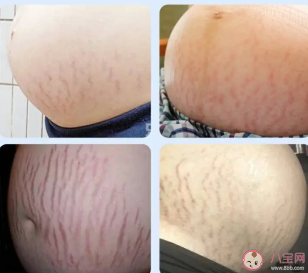 女性為什么會出現妊娠紋 如何預防孕期出現妊娠紋 女性為什么會出現妊娠紋 如何預防孕期出現妊娠紋