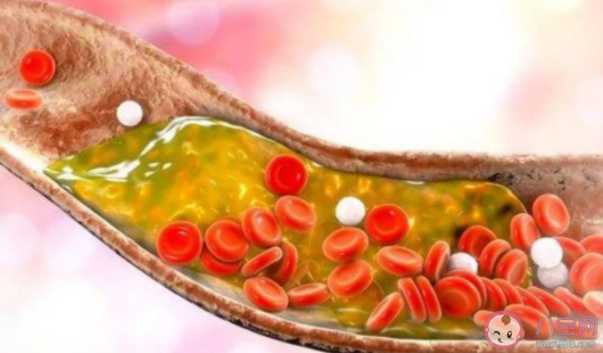 洗血脂能夠預(yù)防高血脂嗎 洗血脂有什么風險