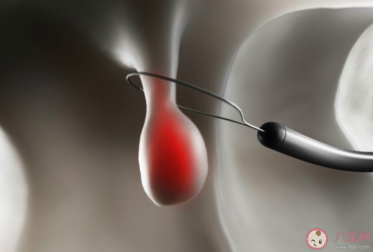 腸息肉切掉了為什么 還會復發 腸道為什么會長息肉