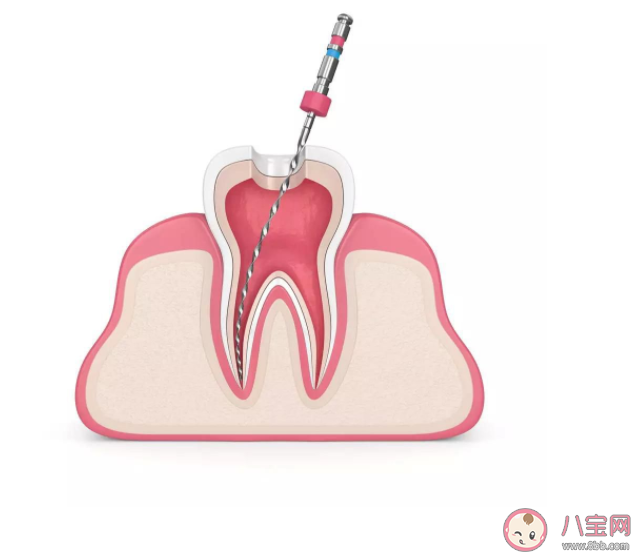 根管治療后為什么還需要做牙冠 做根管治療后要注意什么問(wèn)題