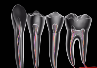 根管治療后為什么還需要做牙冠 做根管治療后要注意什么問題