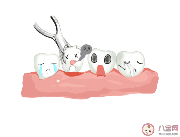 拔牙有哪些禁忌癥 拔牙后的三個關鍵時間點