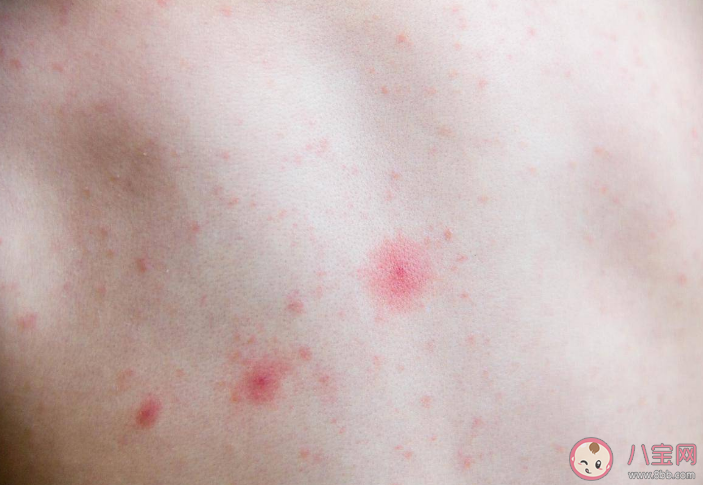 換季過敏自己吃點藥可以嗎 為什么一到換季就過敏 換季過敏自己吃點藥可以嗎 為什么一到換季就過敏