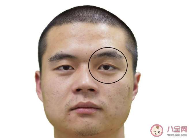 男子連續熬夜加班后眼皮無法抬起是怎么回事 動眼神經麻痹是什么疾病 男子連續熬夜加班后眼皮無法抬起是怎么回事 動眼神經麻痹是什么疾病