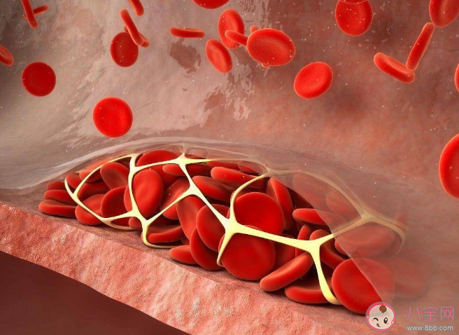 人類血栓中首次發現微塑料 血栓是如何形成的