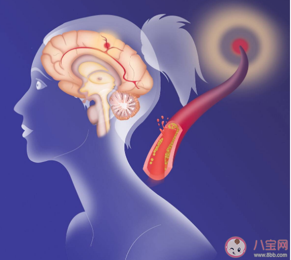 為什么天冷會誘發腦卒中 預防心腦血管疾病發生要從這5個方面入手