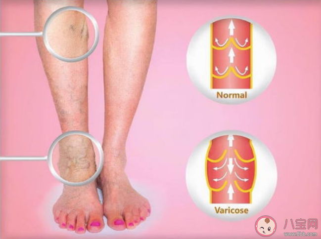 7個跡象發現致命血栓 什么環境下容易長血栓 7個跡象發現致命血栓 什么環境下容易長血栓