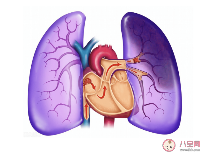 2022世界血栓日主題是什么 預防血栓做好7件小事 2022世界血栓日主題是什么 預防血栓做好7件小事
