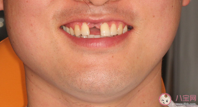 缺牙讓預期壽命縮短11.7年 牙齒缺失有什么危害