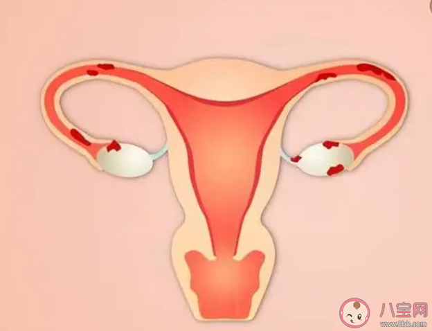 子宮內(nèi)膜異位會怎么樣 子宮內(nèi)膜異位有哪些癥狀