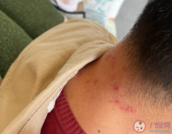 日本梅毒確診者年度累計首超1萬例 為什么會得梅毒