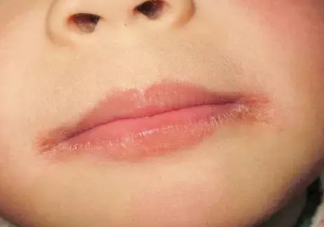 秋冬容易爛嘴角有哪些原因 怎樣預防爛嘴角