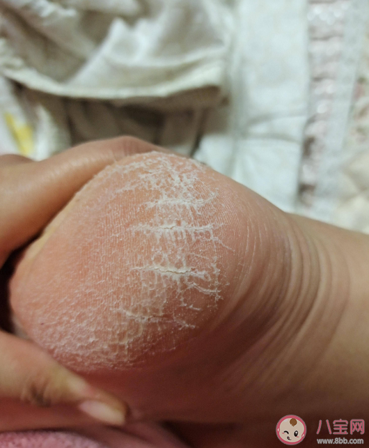為什么有些人腳后跟總開裂 足跟干裂如何預(yù)防