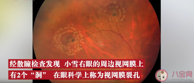 考研女生用眼過度視網膜裂孔 視網膜裂孔有什么癥狀