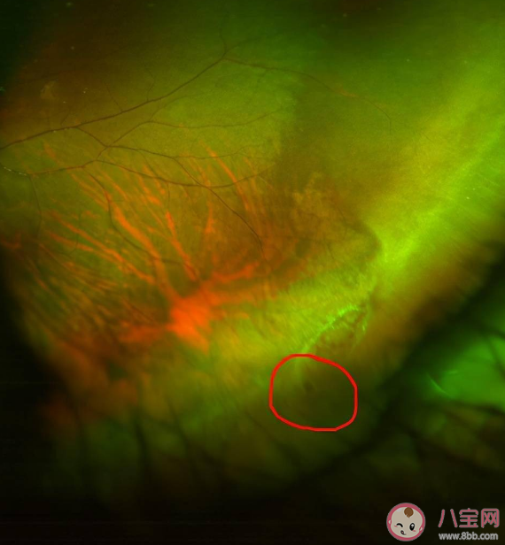 考研女生用眼過度視網膜裂孔 視網膜裂孔有什么癥狀