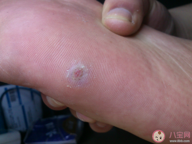 去除腳上的雞眼用什么辦法更好 腳上為什么會長雞眼
