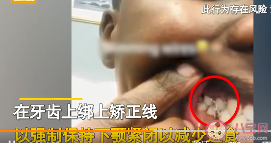 女子為減肥綁牙齒讓嘴巴閉合 怎樣看待極端的減肥方式