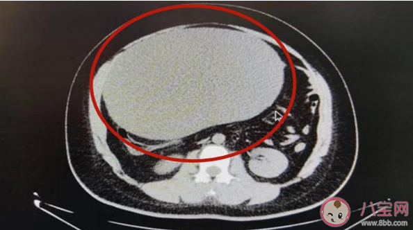 女子以為發(fā)胖肚中取出16斤囊腫 卵巢囊腫有哪些癥狀 女子以為發(fā)胖肚中取出16斤囊腫 卵巢囊腫有哪些癥狀