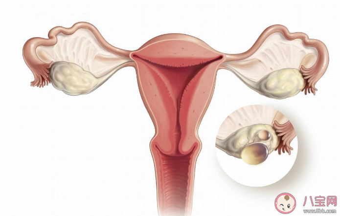 女子以為發(fā)胖肚中取出16斤囊腫 卵巢囊腫有哪些癥狀 女子以為發(fā)胖肚中取出16斤囊腫 卵巢囊腫有哪些癥狀