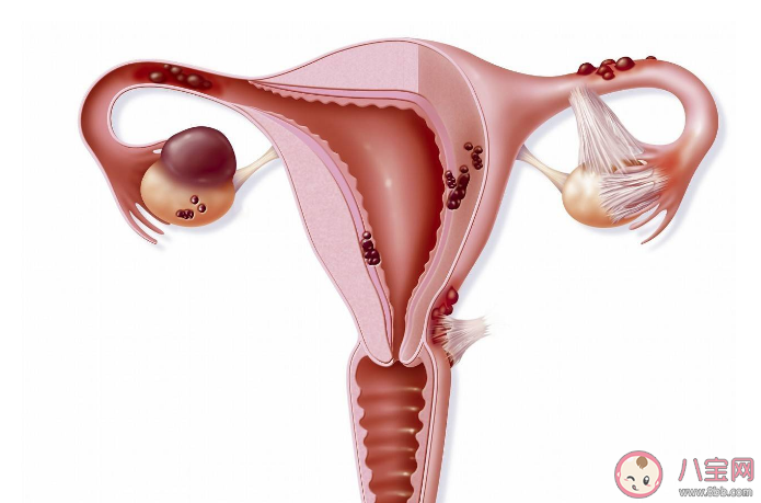 女子以為發(fā)胖肚中取出16斤囊腫 卵巢囊腫有哪些癥狀 女子以為發(fā)胖肚中取出16斤囊腫 卵巢囊腫有哪些癥狀