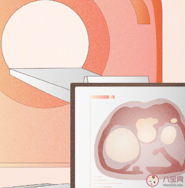 女子以為發(fā)胖肚中取出16斤囊腫是真的嗎 卵巢囊腫是怎么回事