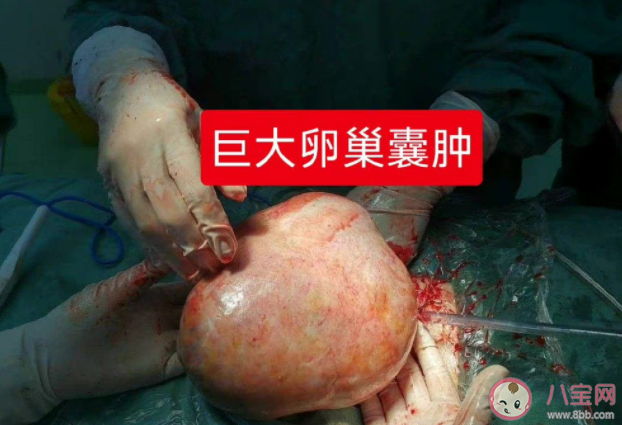 女子以為發(fā)胖肚中取出16斤囊腫是真的嗎 卵巢囊腫是怎么回事
