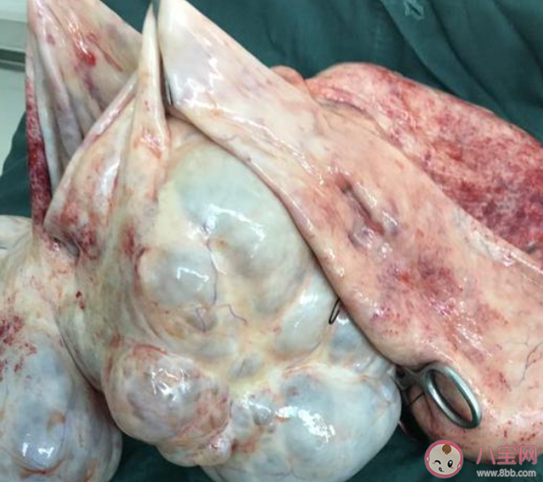 女子以為發(fā)胖肚中取出16斤囊腫是真的嗎 卵巢囊腫是怎么回事