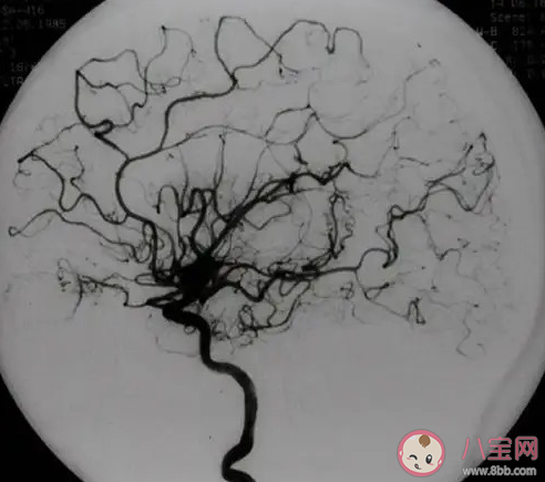 身體發麻要警惕煙霧病 煙霧病是什么疾病有什么危害