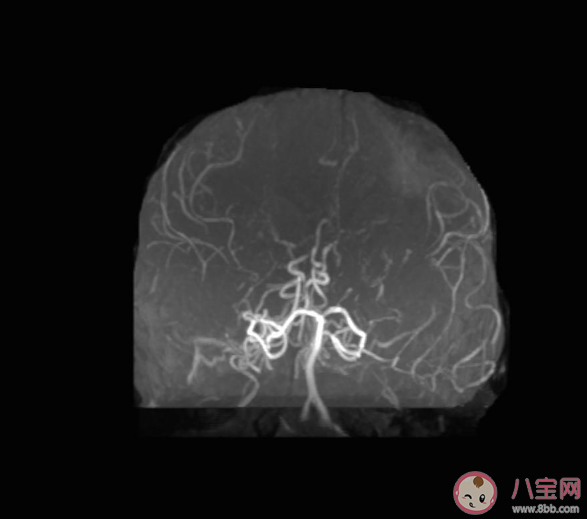 身體發麻要警惕煙霧病 煙霧病是什么疾病有什么危害