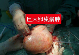 女子以為發胖肚中取出16斤囊腫是真的嗎 卵巢囊腫是怎么回事