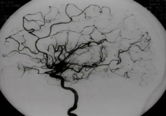 身體發麻要警惕煙霧病 煙霧病是什么疾病有什么危害