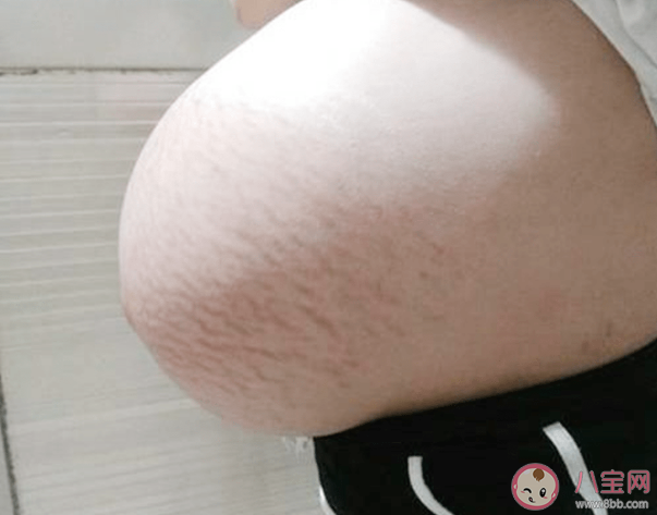 孕婦懸浮肚分娩有什么困難的 懷孕懸浮肚的原因是什么