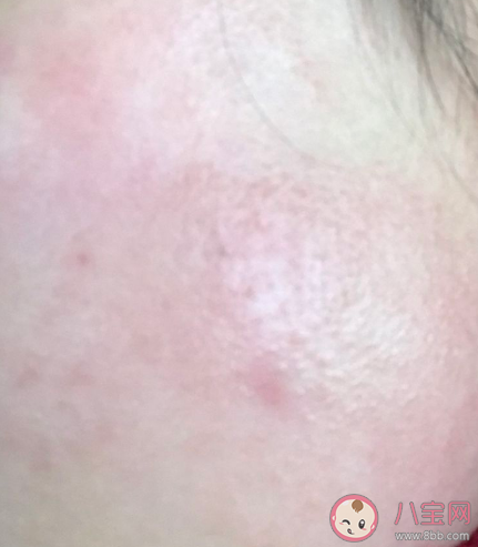 人為什么會過敏 過敏緩解了可以停藥嗎