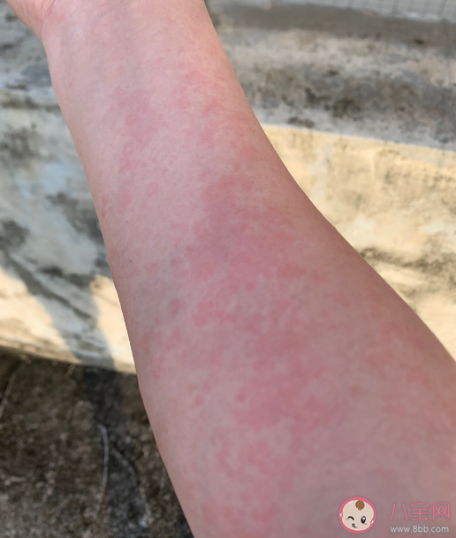 人為什么會過敏 過敏緩解了可以停藥嗎