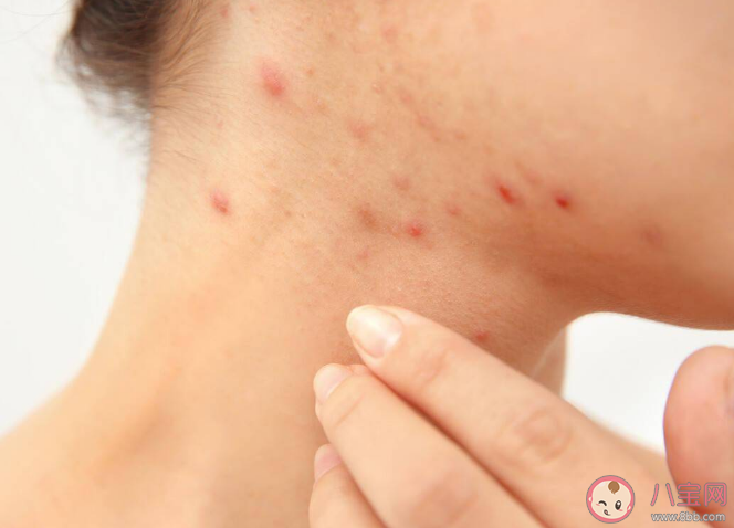 人為什么會過敏 過敏緩解了可以停藥嗎