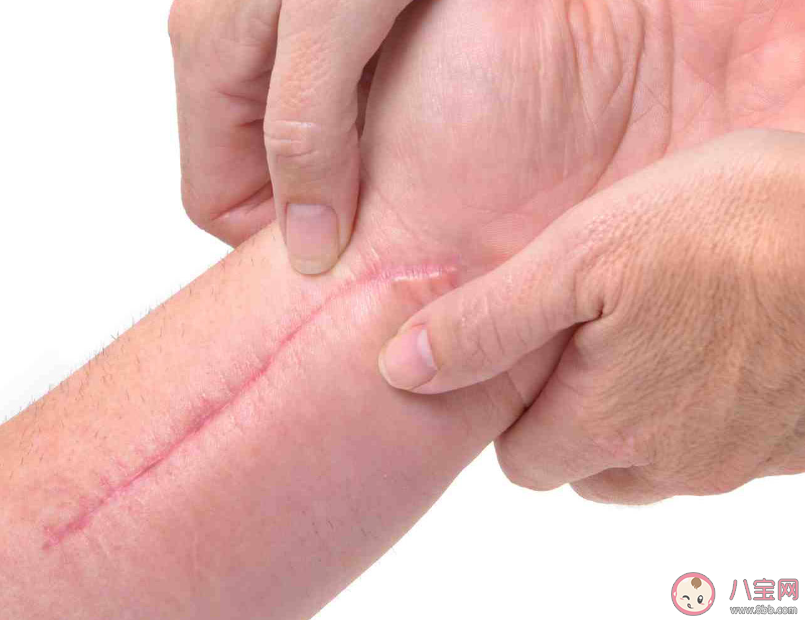 疤痕體質的說法靠譜嗎 疤痕體質能改變嗎 疤痕體質的說法靠譜嗎 疤痕體質能改變嗎