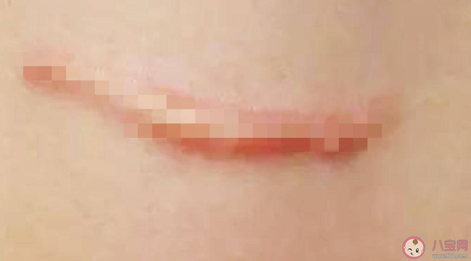 疤痕體質的說法靠譜嗎 疤痕體質能改變嗎 疤痕體質的說法靠譜嗎 疤痕體質能改變嗎