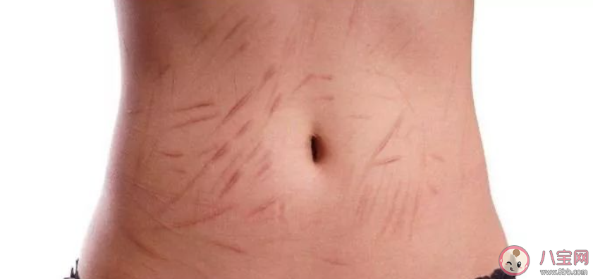 疤痕體質的說法靠譜嗎 疤痕體質能改變嗎 疤痕體質的說法靠譜嗎 疤痕體質能改變嗎