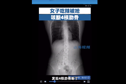 女子吃辣被嗆咳斷4根肋骨 太瘦的人肋骨更容易斷嗎