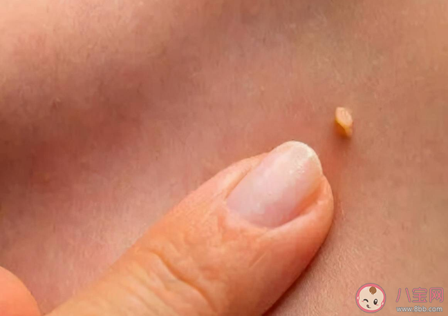 絲狀疣需要治療嗎 絲狀疣跟女性宮頸HPV有關(guān)系嗎