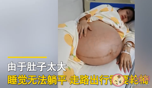 女子二胎懷3胞胎出行要靠輪椅 懷3胞胎有多辛苦