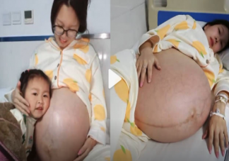 女子二胎懷3胞胎出行要靠輪椅是什么情況 懷了多胞胎需要注意什么
