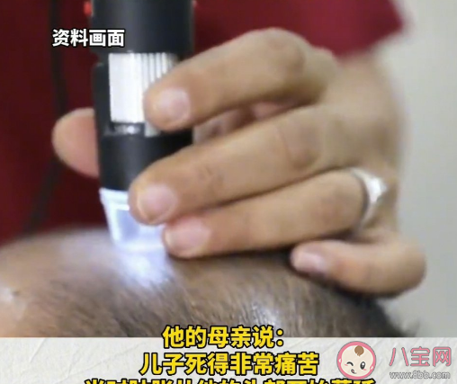 30歲男子植發(fā)后多器官衰竭死亡 植發(fā)手術(shù)有什么風(fēng)險(xiǎn)