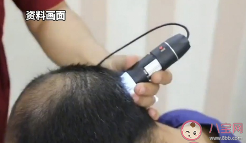 30歲男子植發(fā)后多器官衰竭死亡 植發(fā)手術(shù)有什么風(fēng)險(xiǎn)