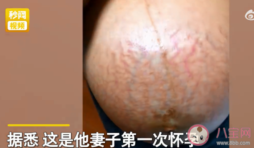 男子稱妻子孕肚像被蜈蚣爬滿太恐怖 妊娠紋該如何消除
